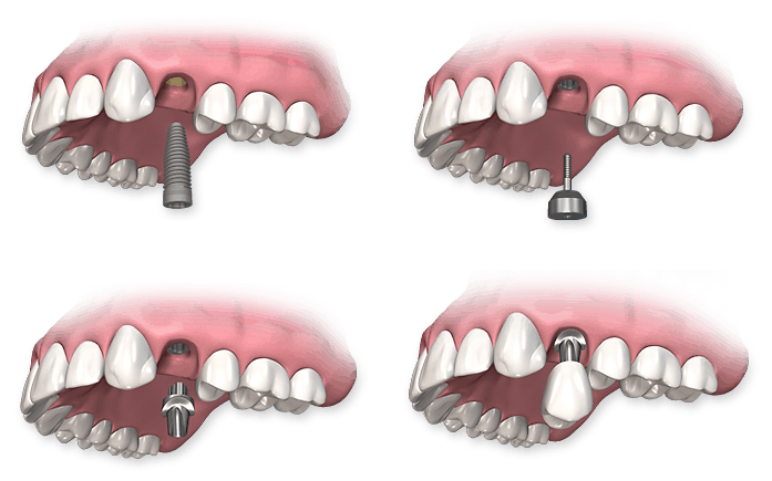 Dental implant procedure showing tooth and implant at Turlock Dental Implants.