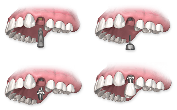 Turlock Dental Implants