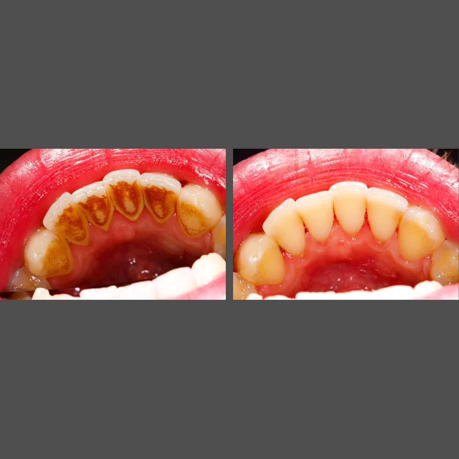 Before and after images of a dental implant procedure at American Family Dentistry, illustrating significant smile improvement.