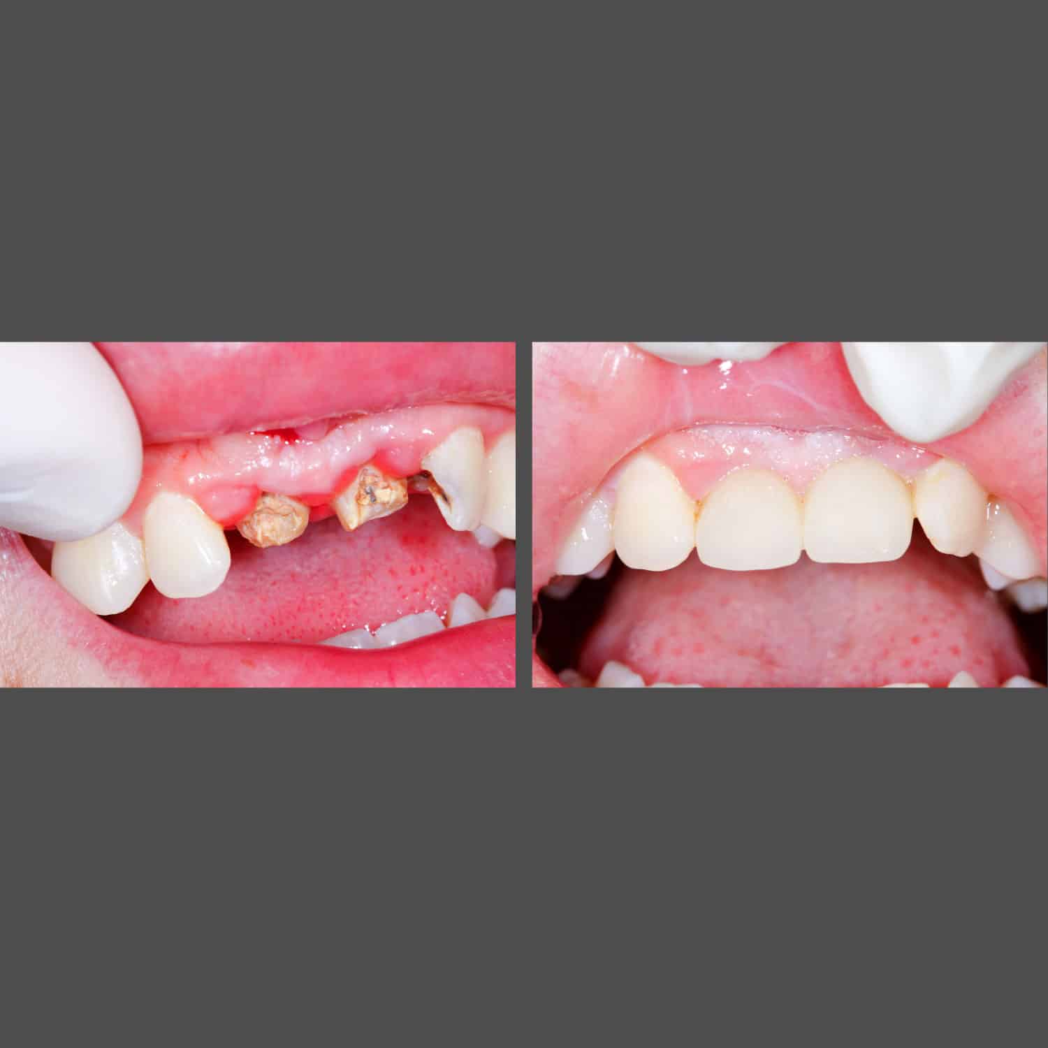A comparative image illustrating the restoration of a missing tooth at American Family Dentistry, emphasizing the dental improvement.