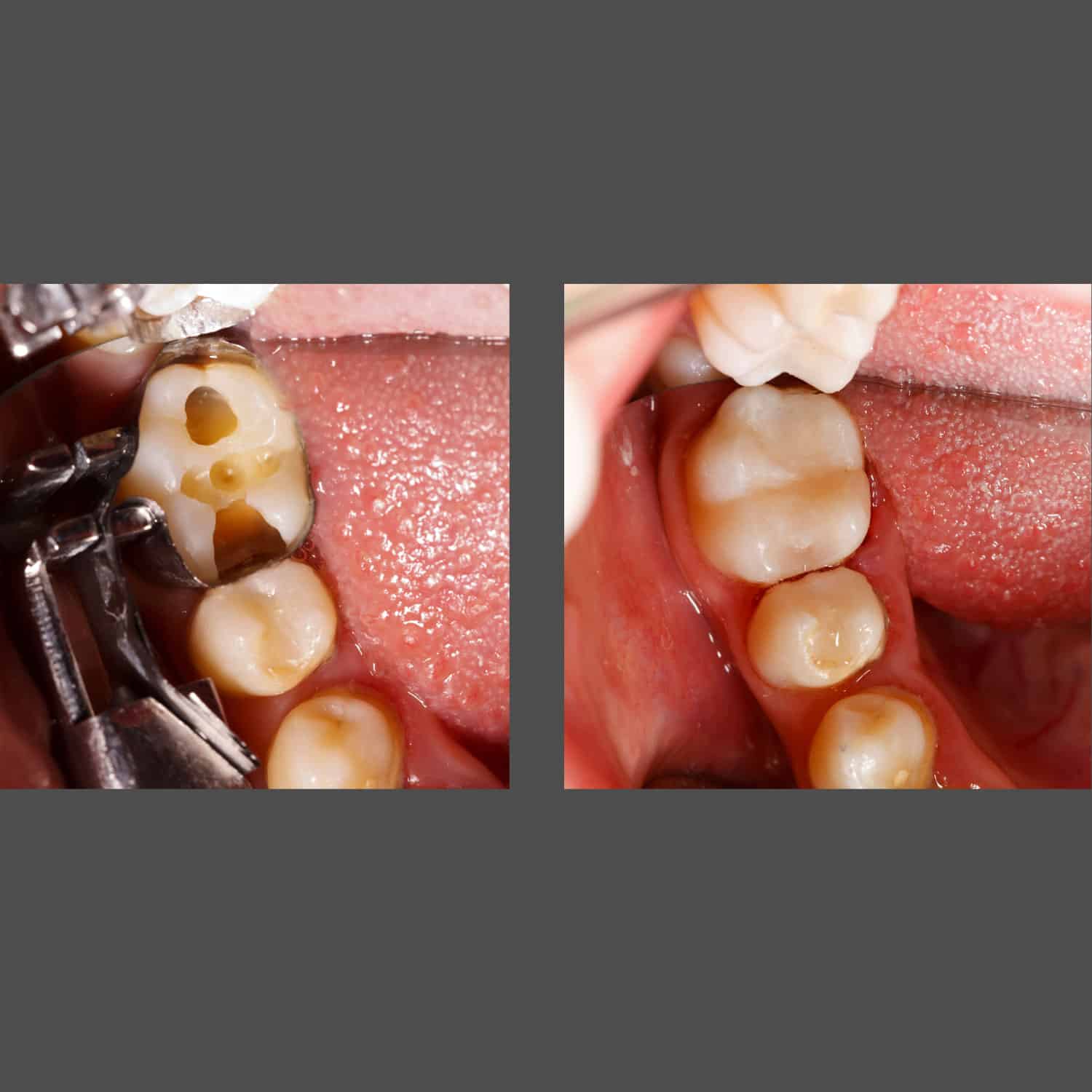 An image depicting a tooth with a gap and another tooth also missing a part, representing dental health at American Family Dentistry.