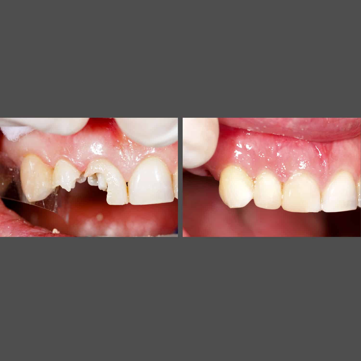 Before and after dental implant transformation at American Family Dentistry, showcasing improved smile and dental health.