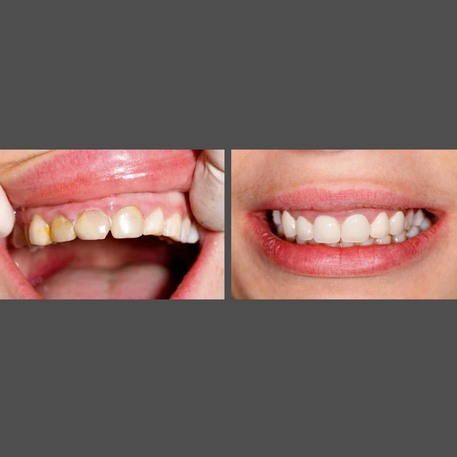 Before and after photos illustrating a child's dental progress at American Family Dentistry, emphasizing enhanced tooth appearance.