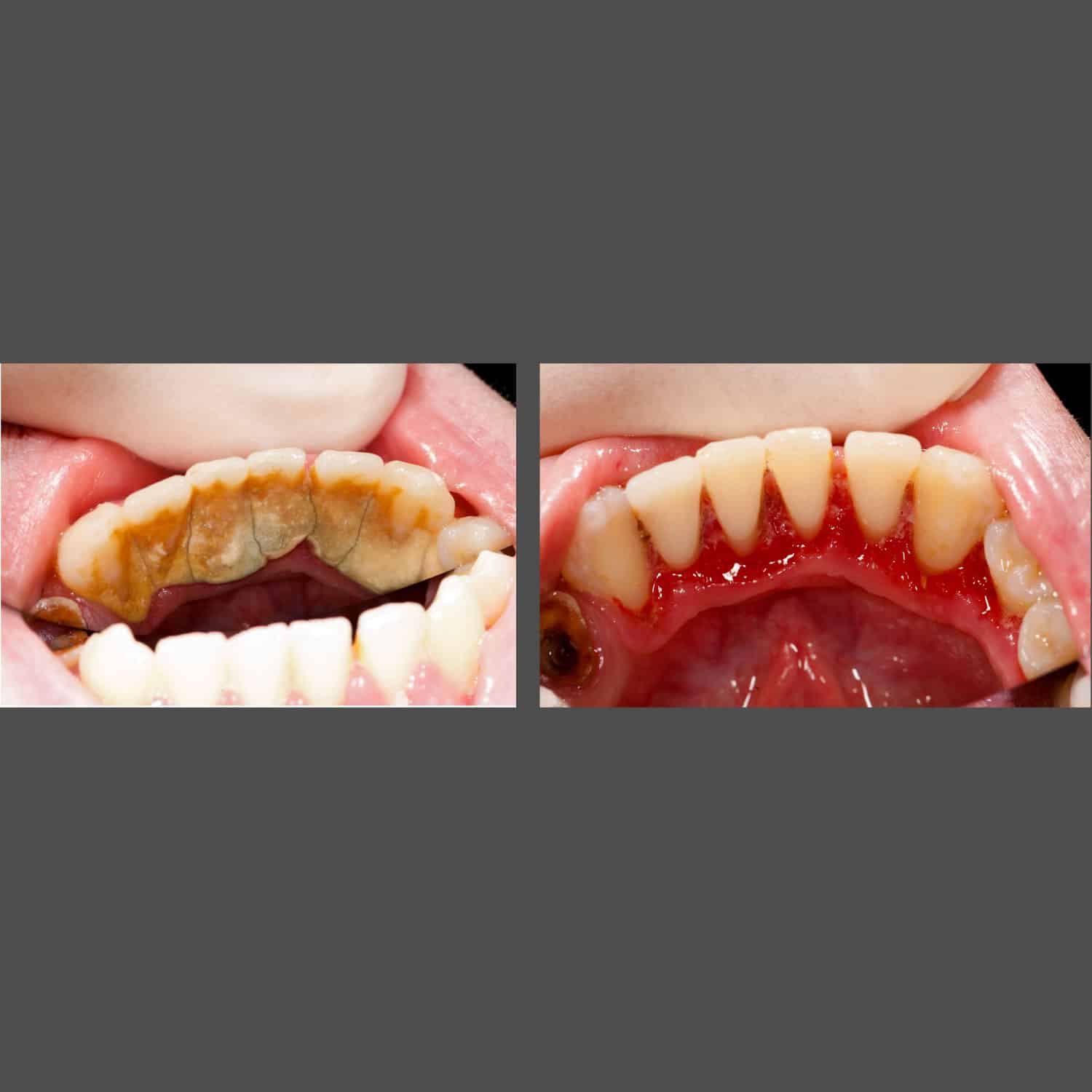 Side-by-side images depicting the results of dental implants, emphasizing the positive change in appearance and oral function.