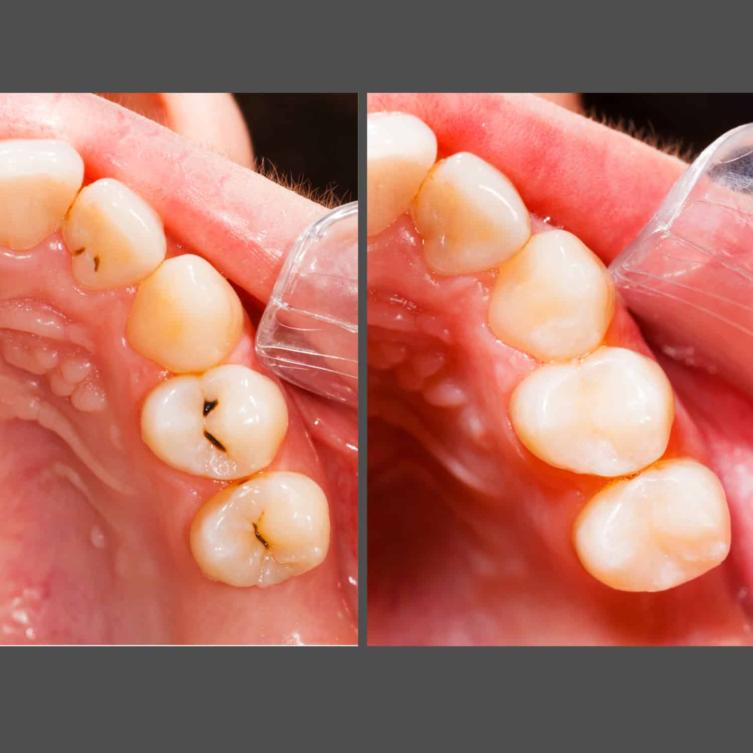 Before and after images showcasing the transformation achieved highlighting improved aesthetics.