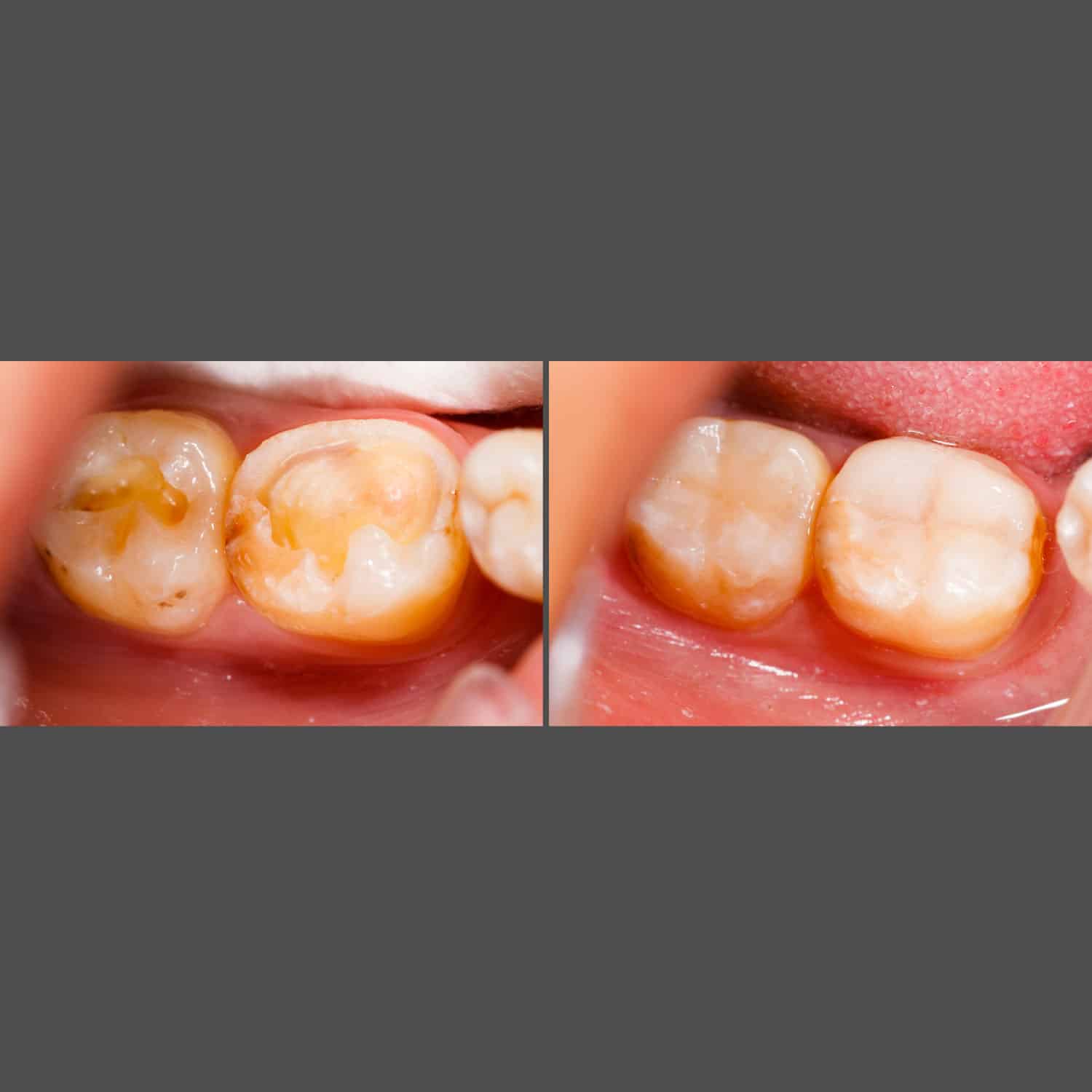 Side-by-side images depicting the results of a dental implant, emphasizing the positive change in oral health and smile.
