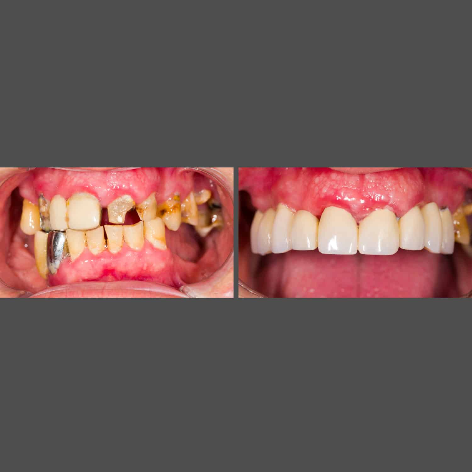 Before and after images showcasing the transformation of a smile with a dental implant procedure.