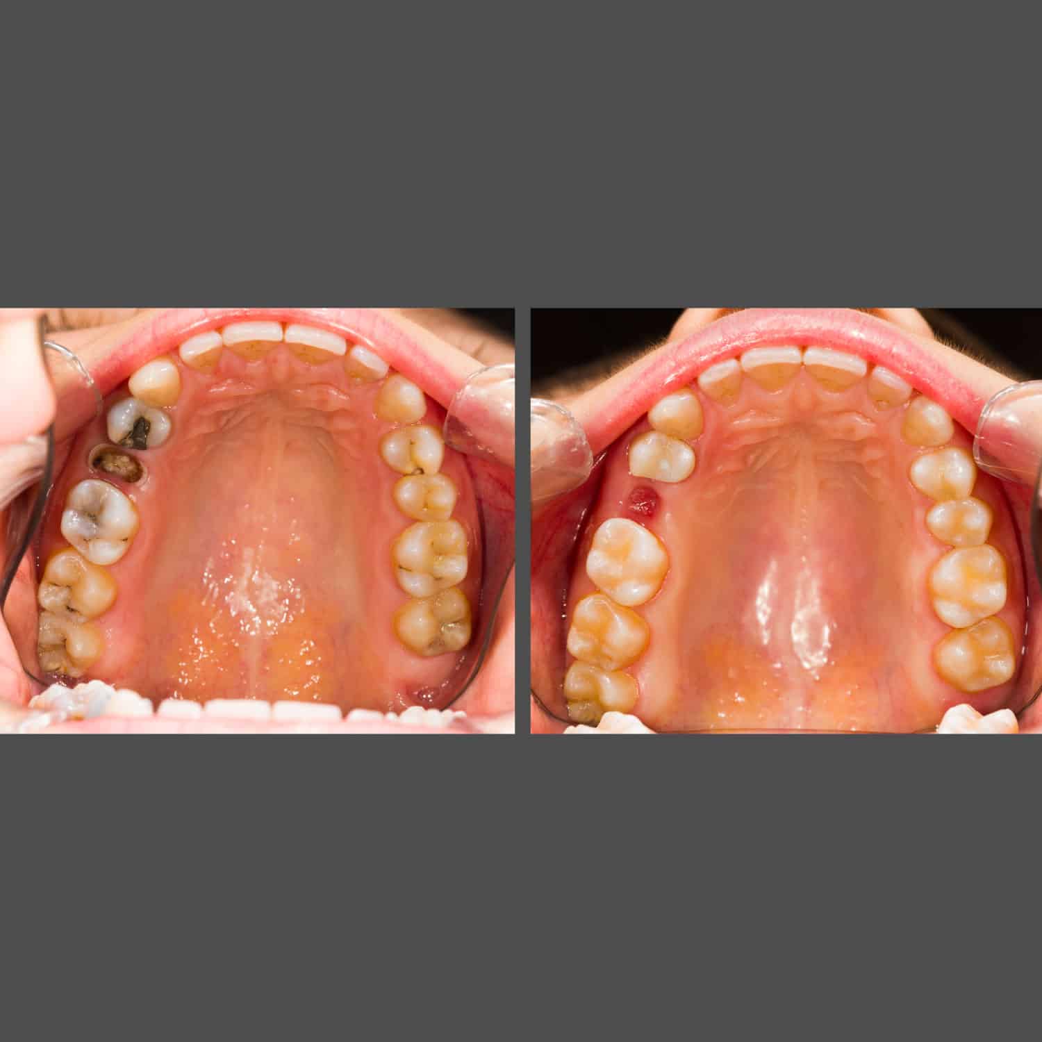 Visual representation of a tooth's condition before and after dental implant placement, demonstrating effective restoration results.