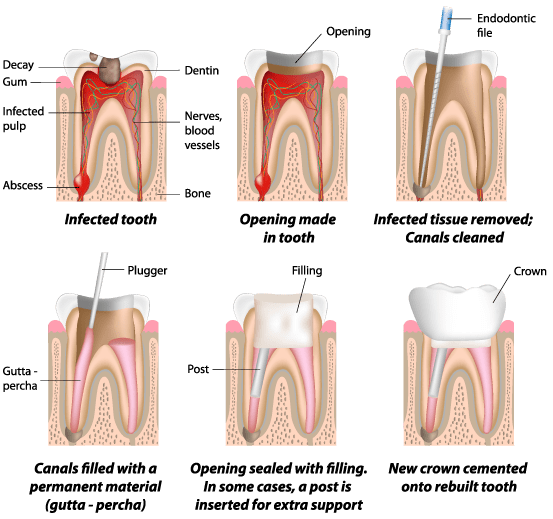 Dental implant treatment procedure showcasing the placement of an implant in a patient's jawbone for tooth restoration.