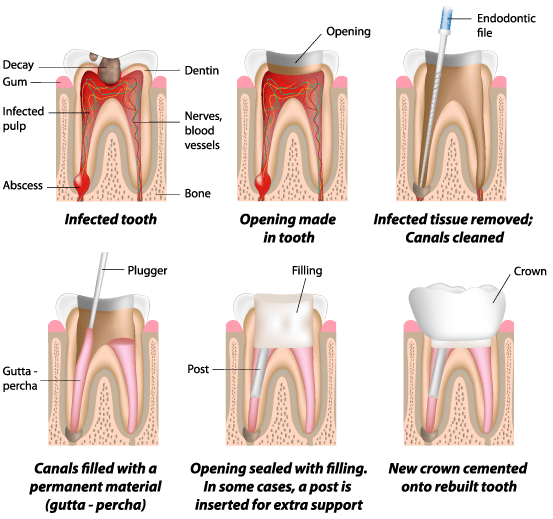 Turlock Root Canals