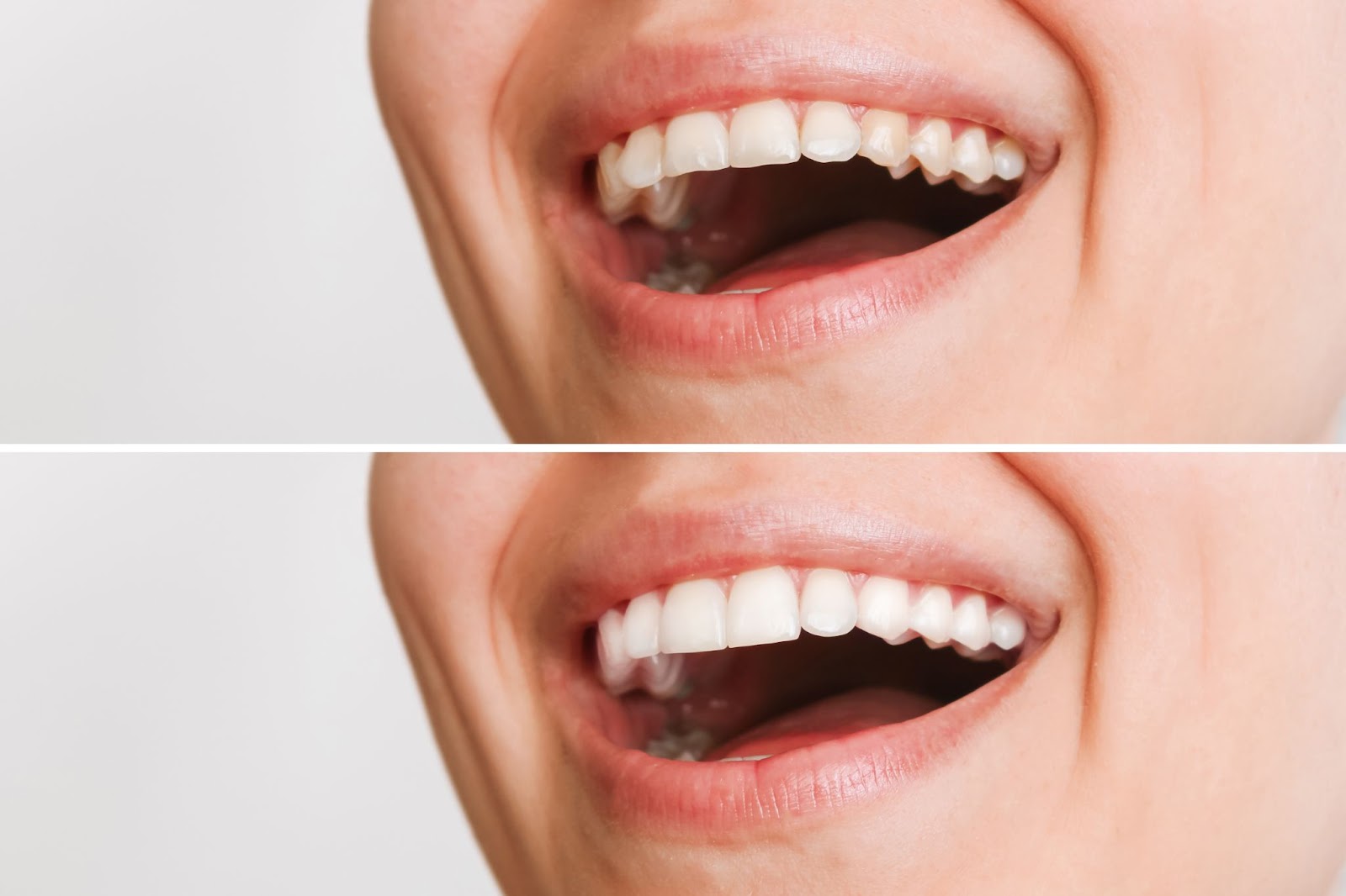 A woman with white teeth before and after teeth whitening at family dental.