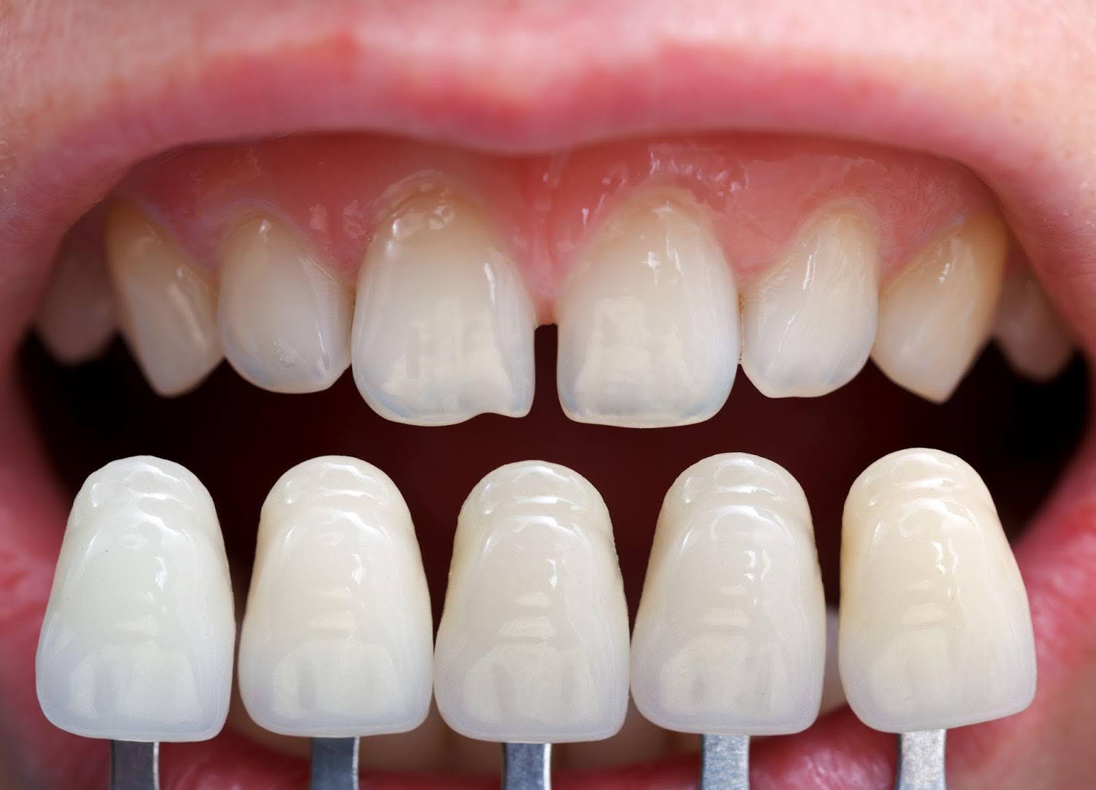 How Long Do Cosmetic Teeth Veneers Last? Maintenance Tips and More